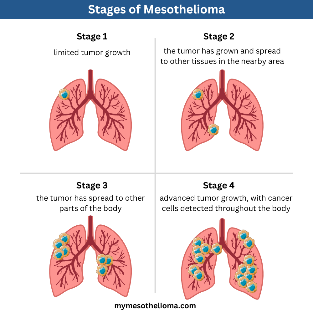 stages of mesothelioma