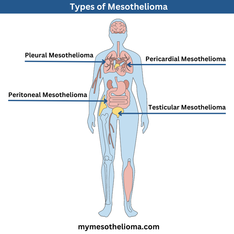 types of mesothelioma 