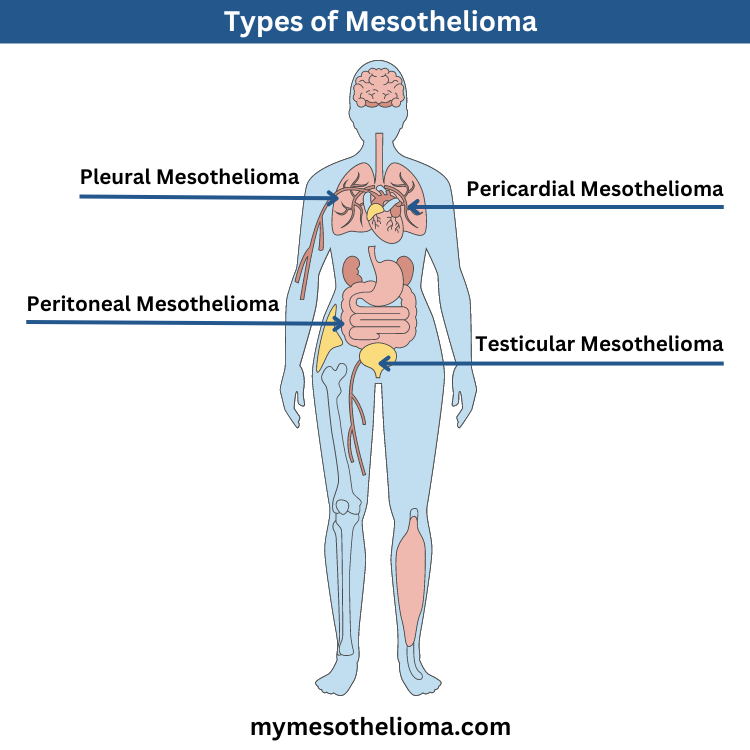 types of mesothelioma